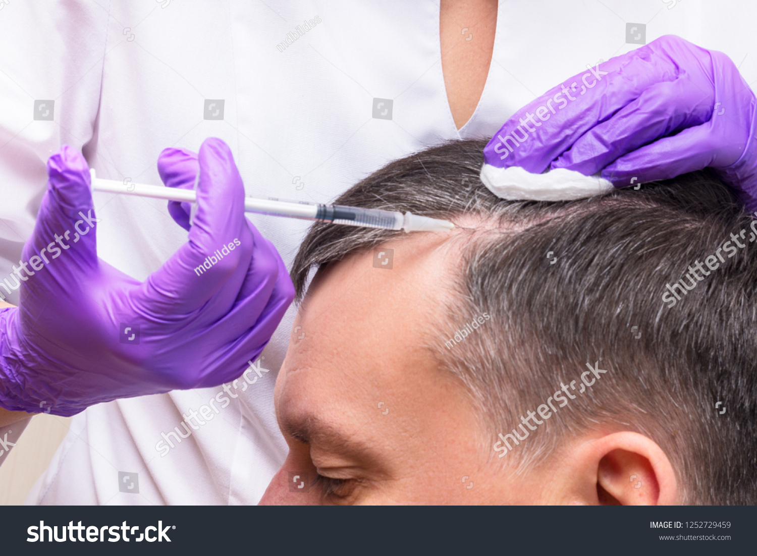 stock-photo-injection-treatment-for-hair-loss-1252729459 ...